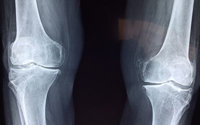 Applying for Social Security Disability because of knee pain