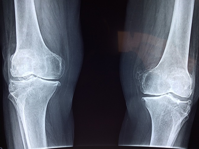 Applying for Social Security Disability because of knee pain